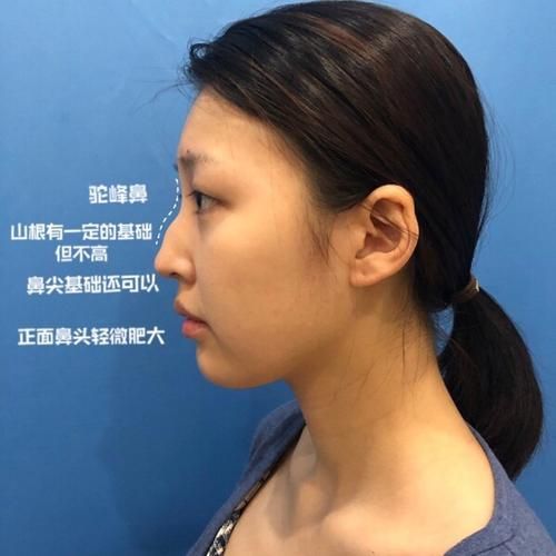 駝峰鼻子(真的能通過(guò)手術(shù)變得更美嗎)