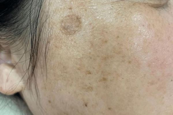 臉上長老年斑是什么原因(還是睡眠不足導(dǎo)致的)